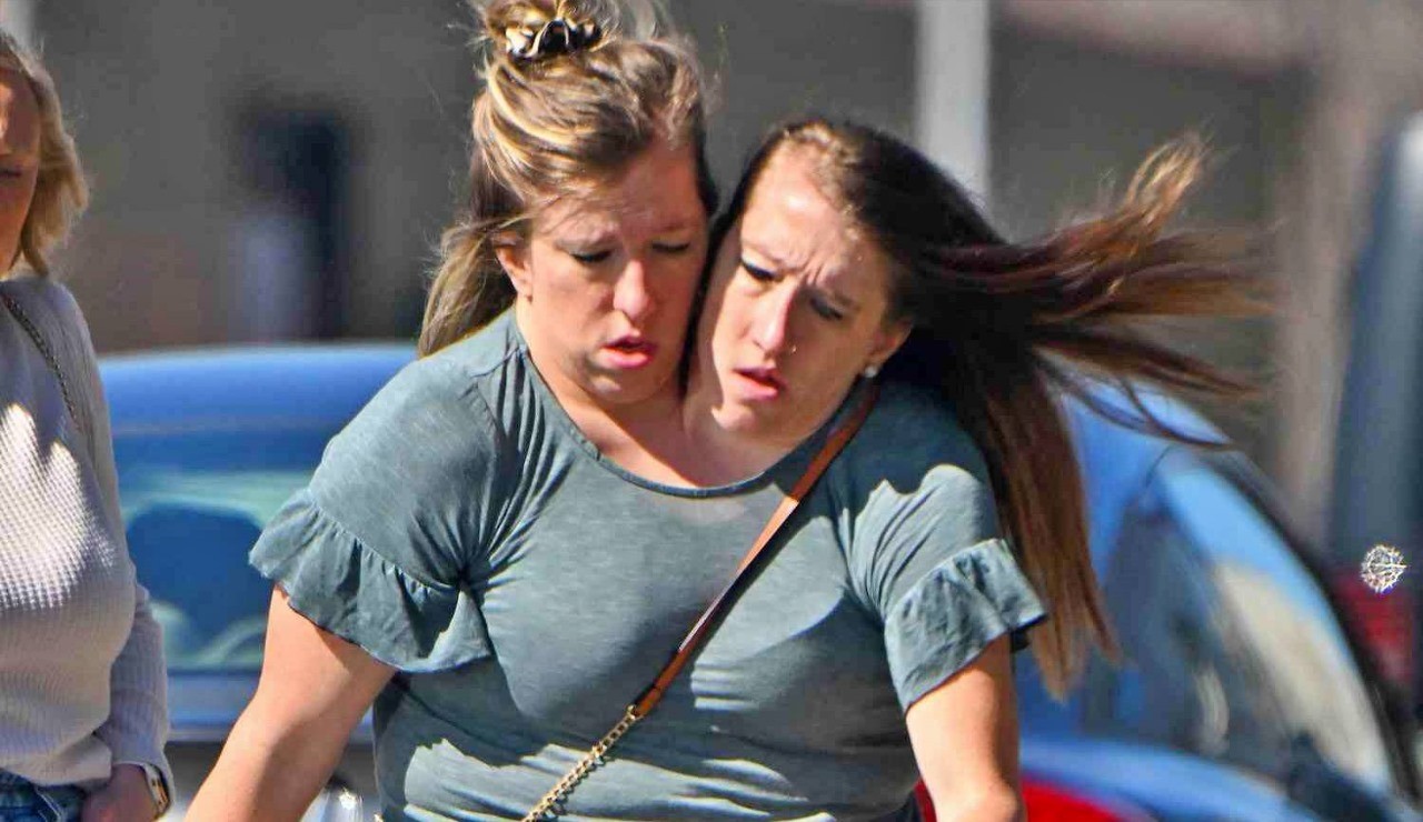 Conjoined twins image
